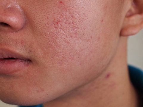 Dermatologist recommended For daily use Oil-free formula-before